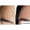 Vakuuminis veido porų valymo prietaisas, Skinbeat