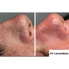 Vakuuminis veido porų valymo prietaisas, Skinbeat