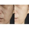 Beautifly B-Derma Glow Pro