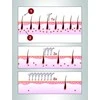 „BeautyRelax IPL Premium“ epiliatorius BR-1400