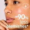 Iroha ACNE PRONE SKIN Microdart Pimple Patches with Salicylic Acid 12 Units