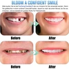 2 poros dantų lukštai Smile, patogūs momentiniai kosmetiniai dantų lukštai viršutiniams ir apatiniams dantims vyrams ir moterims, dantų balinimo uždengimas blogiems dantims