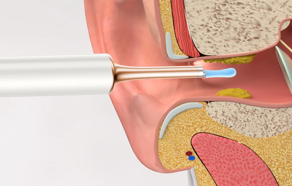 Smart Visual Ear-Clean Rod Bebird Note 5 pro - baltas aprašymas - Prekės nuotrauka Smart Visual Ear-Clean Rod Bebird Note 5 pro - baltas aprašymas - Prekės nuotrauka