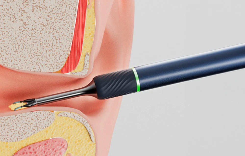 Smart Visual Ear-Clean Rod Bebird Note 5 (balta) aprašymas - Prekės nuotrauka Smart Visual Ear-Clean Rod Bebird Note 5 (balta) aprašymas - Prekės nuotrauka