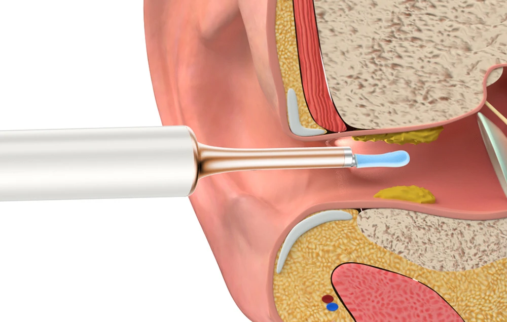 Smart Visual Ear-Clean strypas Bebird T15 baltas aprašymas - Prekės nuotrauka
