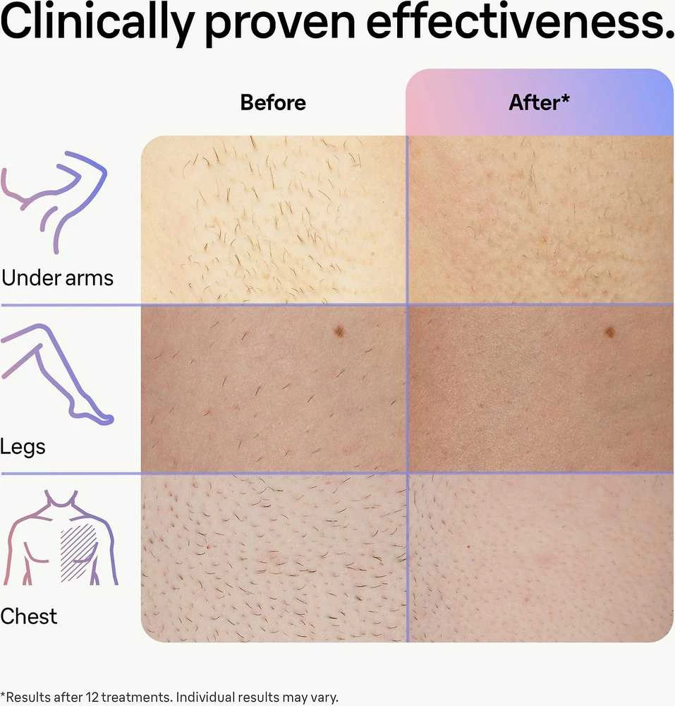 Fotoepiliatorius Braun Silk-Expert Pro IPL PL7253,  Intensyvaus pulso šviesa (IPL) „Rose Gold“, Balta