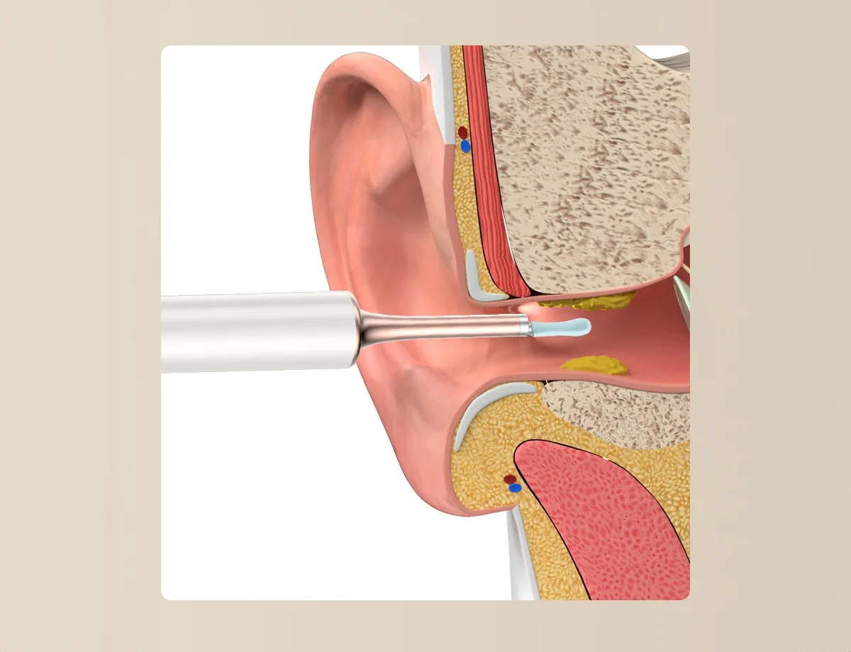 Bebird T15 Juodas Ear Cleaning Otoscope with Camera, 1080p aprašymas - Prekės nuotrauka