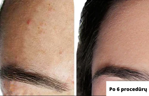 Vakuuminis veido porų valymo prietaisas, Skinbeat