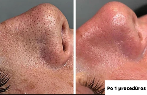 Vakuuminis veido porų valymo prietaisas, Skinbeat