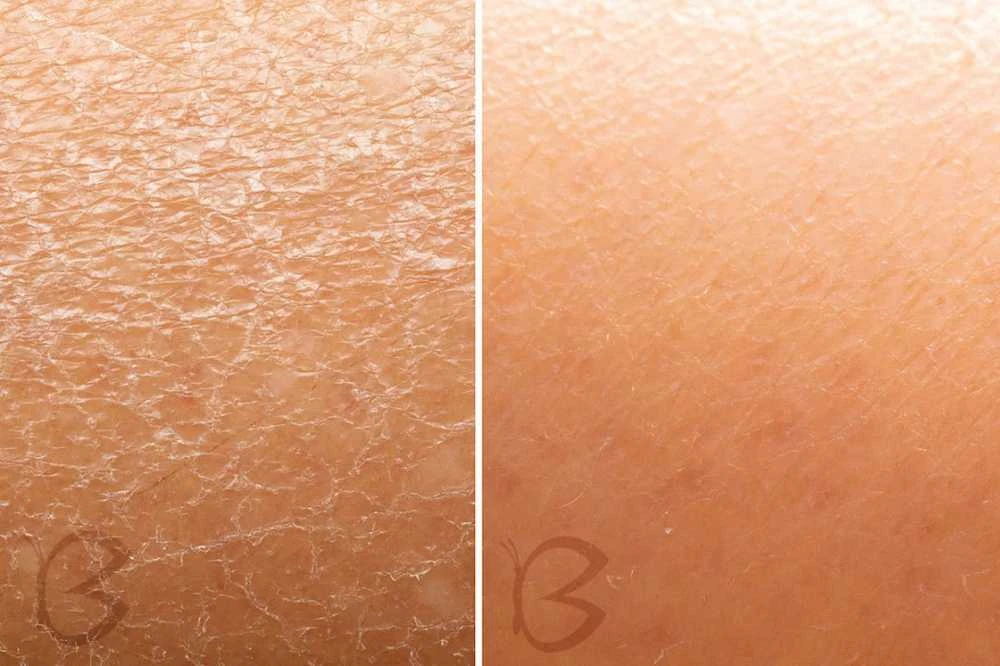 Beautifly B-Derma Glow Pro