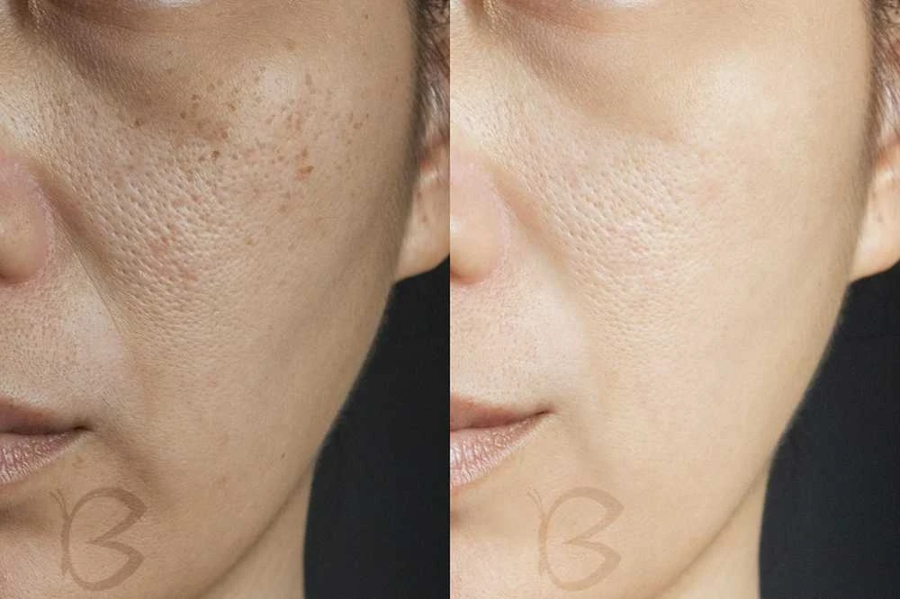 Beautifly B-Derma Glow Pro