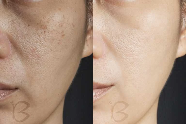 Beautifly B-Derma Ice