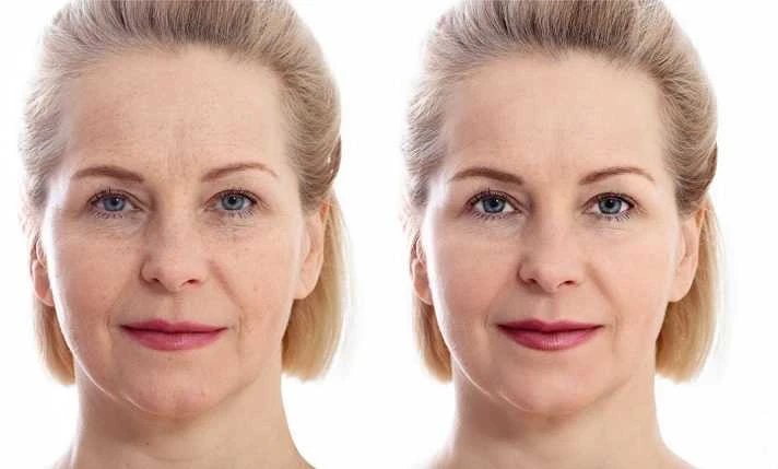 Beadatinės mezoterapijos aparatas Beautifly B-Glossy PRO