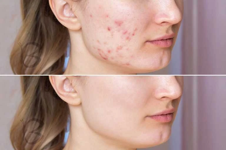 Beautifly B-Shine Ice epiliatorius kūnui IPL, veidui, bikinio sričiai ir pažastims