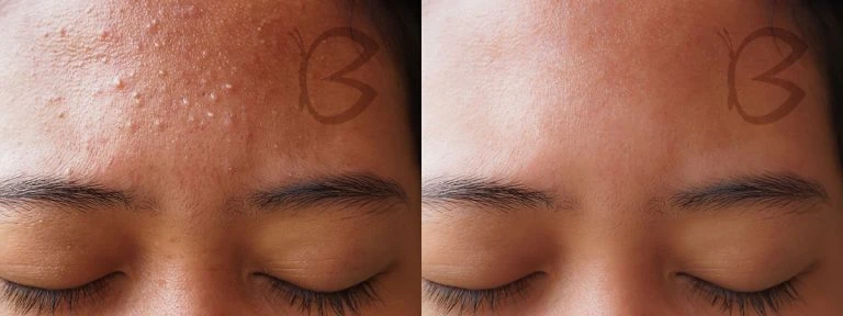 Mezoterapija Beautifly B-Plasma Blush aprašymas - Prekės nuotrauka