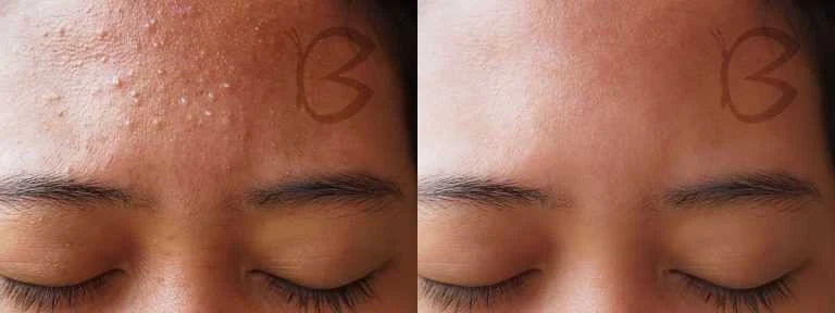 Mezoterapija Beautifly B-Plasma Blush