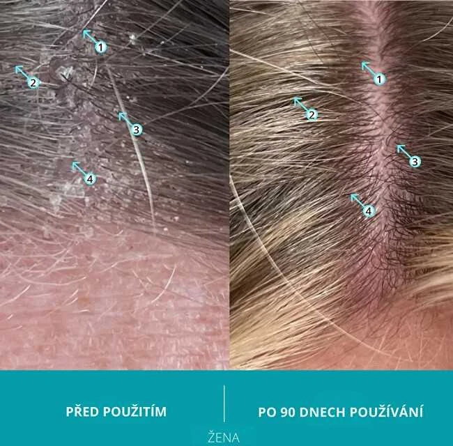 Ds Dandrene Nuo pleiskanų Šampūnas 205ml