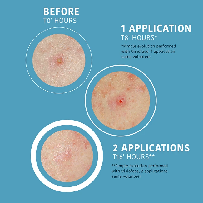 Iroha Nature Hydrocolloide Face & Body SOS Pimple Patches hidrokoloidiniai pleistrai nuo spuogų su salicilio rūgštimi, 1 vnt.