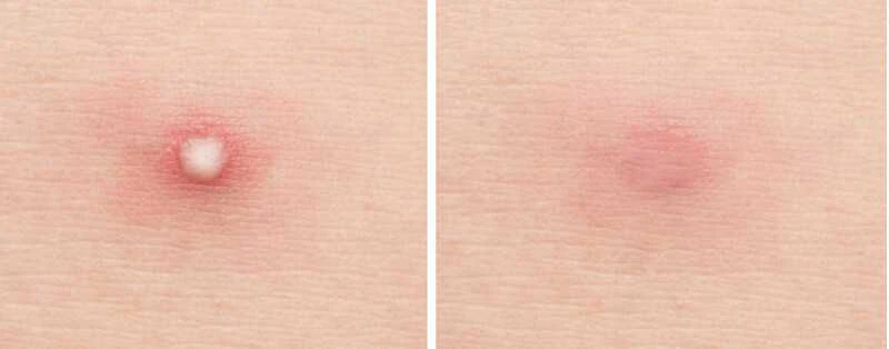 Hidrokoloidiniai, maskuojamieji pleistrai nuo spuogų Mizon Good Bye Blemish Clear Patch, pakuotėje 44 vnt.