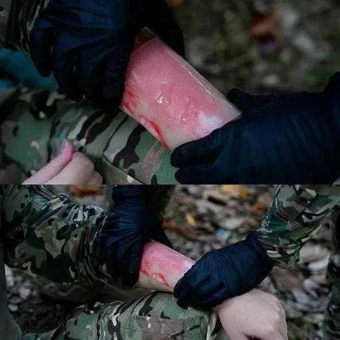 Rhino Rescue Burn Care Kit – vieno žingsnio skubus nudegimų gydymas