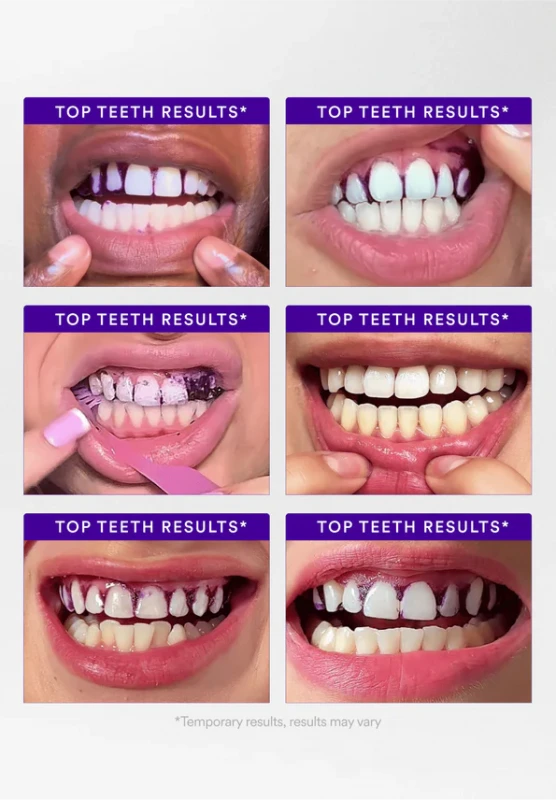 Dantų šepetėlis Hismile V34 Whitening Strips balinimo juostelės 14 vnt