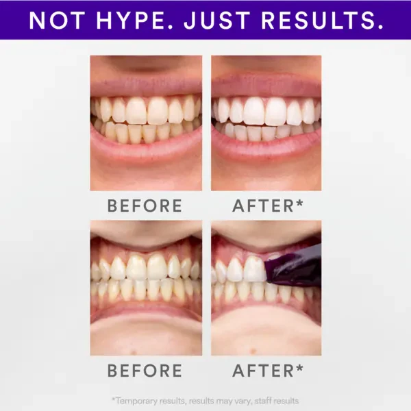 Dantų šepetėlis Hismile V34 Whitening Strips balinimo juostelės 14 vnt