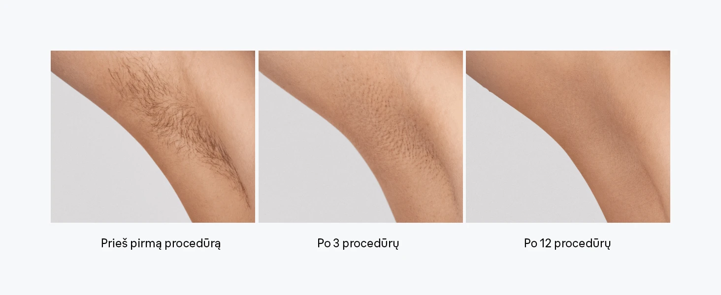 Braun PL1100 Silk-expert IPL mini Fotoepiliatorius aprašymas - Prekės nuotrauka
