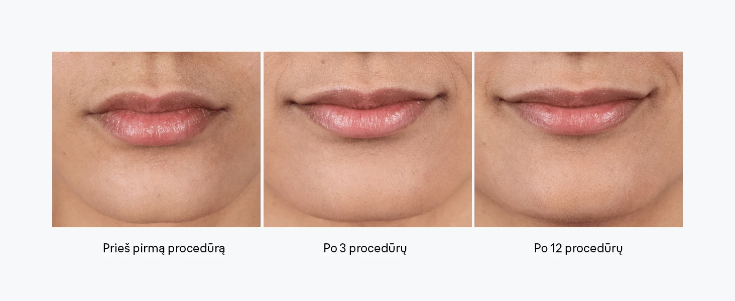 Braun PL1100 Silk-expert IPL mini Fotoepiliatorius aprašymas - Prekės nuotrauka