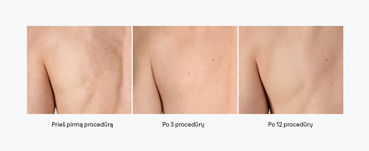 Braun PL1100 Silk-expert IPL mini Fotoepiliatorius aprašymas - Prekės nuotrauka