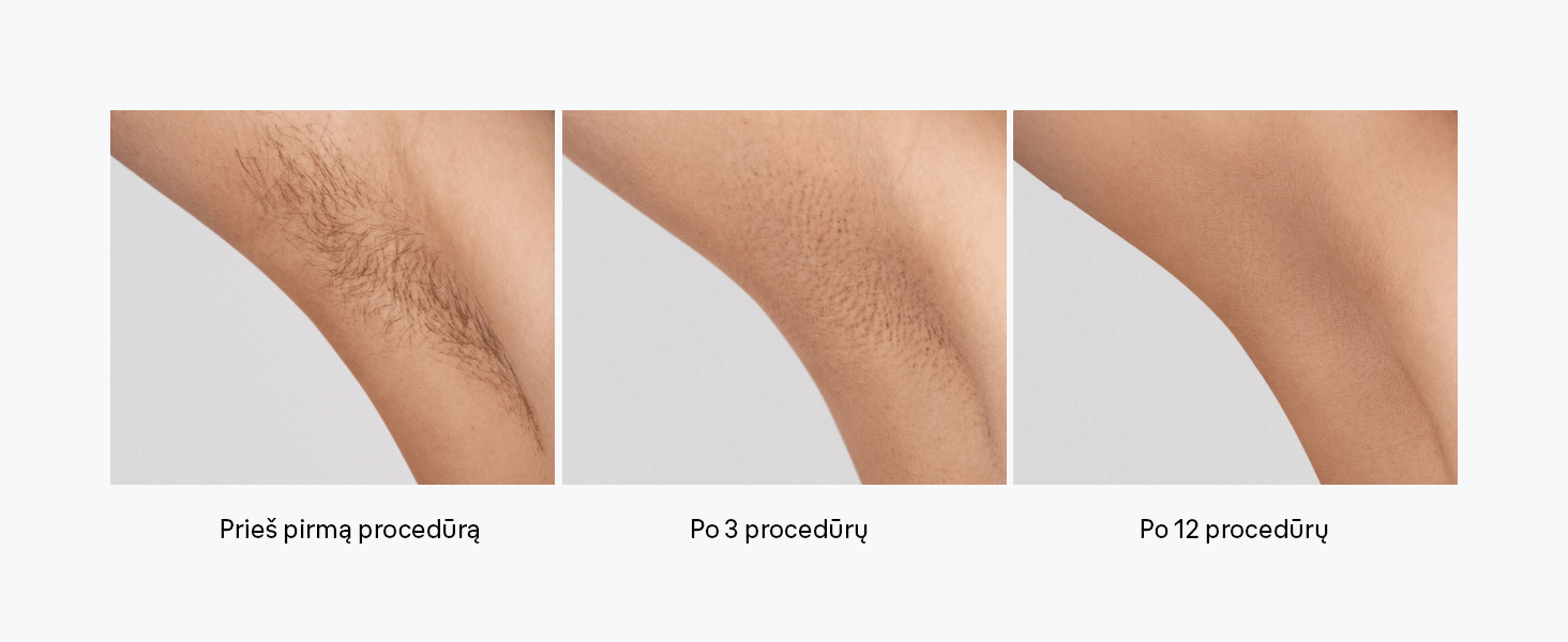 pl1111-silk-expert-ipl-mini-fotoepiliatorius