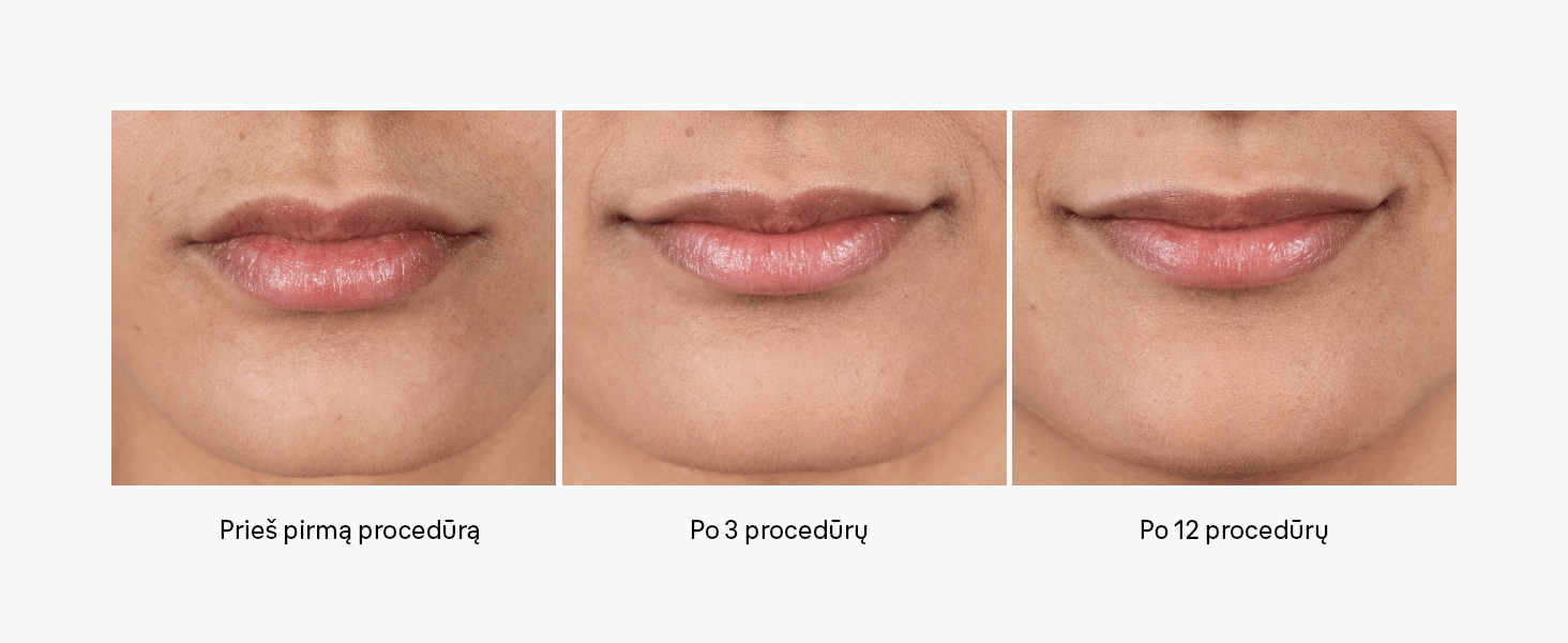 pl1111-silk-expert-ipl-mini-fotoepiliatorius