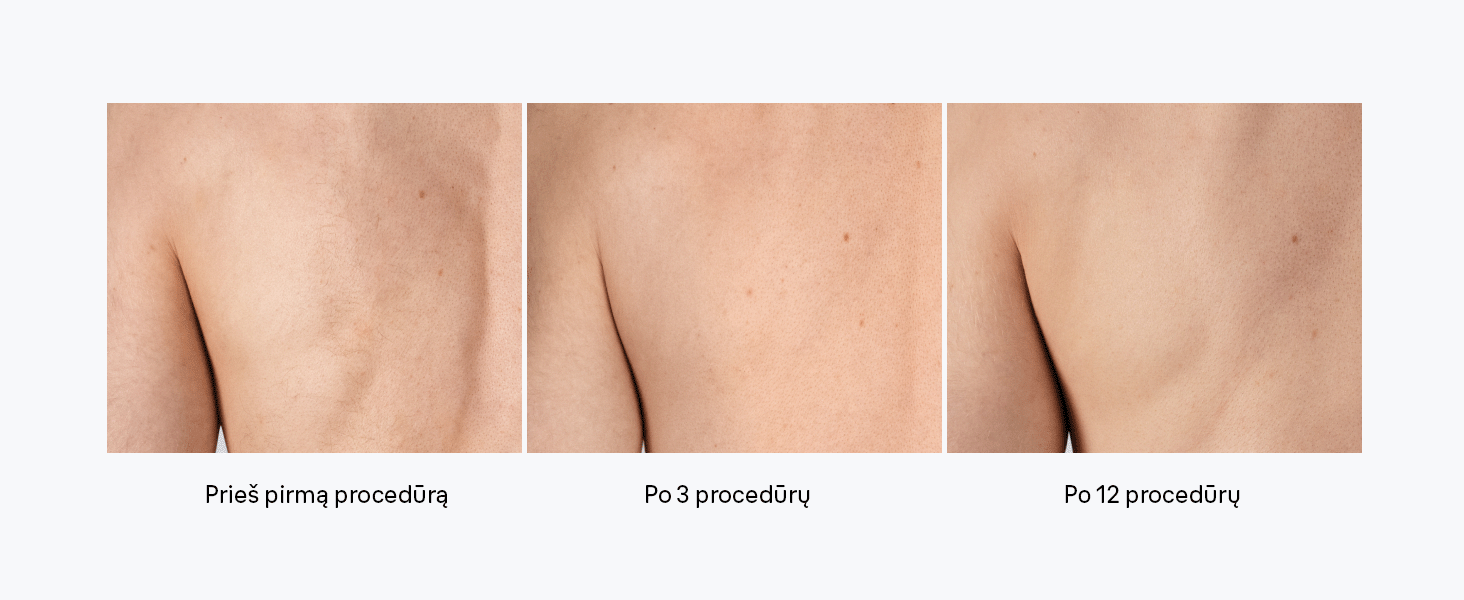 pl1111-silk-expert-ipl-mini-fotoepiliatorius