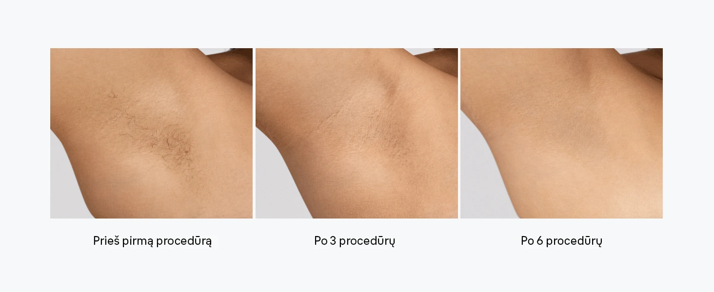 Braun PL5221 Silk-expert Pro 5 IPL Fotoepiliatorius aprašymas - Prekės nuotrauka