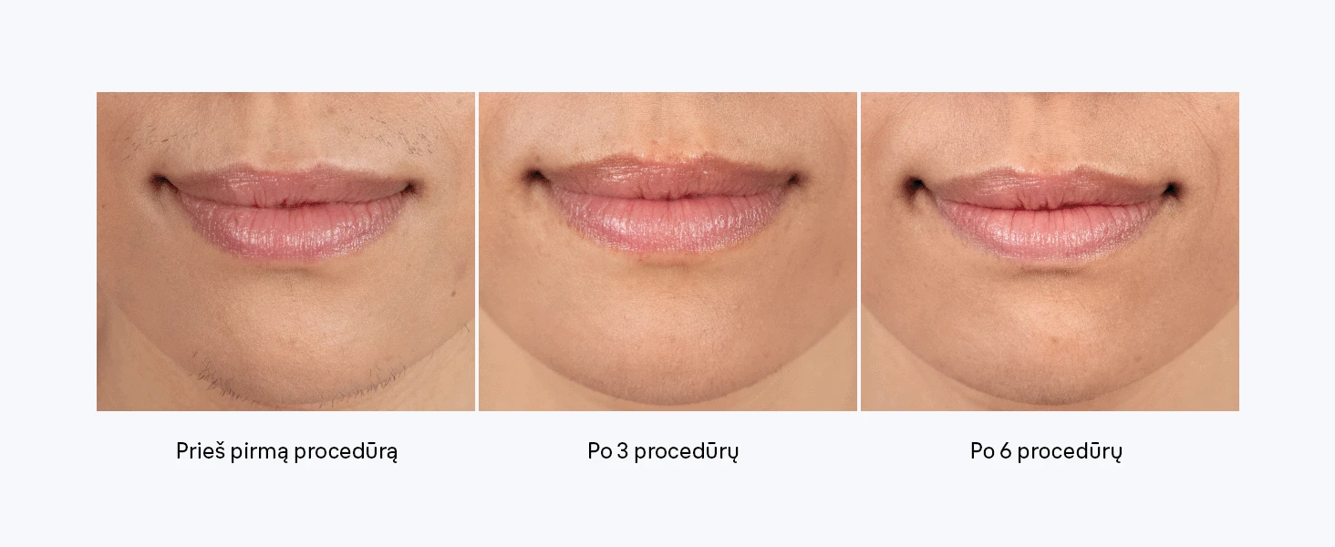 Braun PL5431 Silk-expert Pro 5 IPL Fotoepiliatorius aprašymas - Prekės nuotrauka