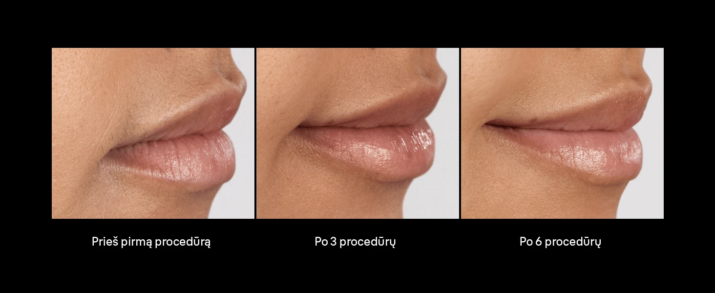 NAUJIENA Braun PL7321 Skin i·expert Pro7 IPL Fotoepiliatorius - Išmanioji alternatyva lazeriui. aprašymas - Prekės nuotrauka