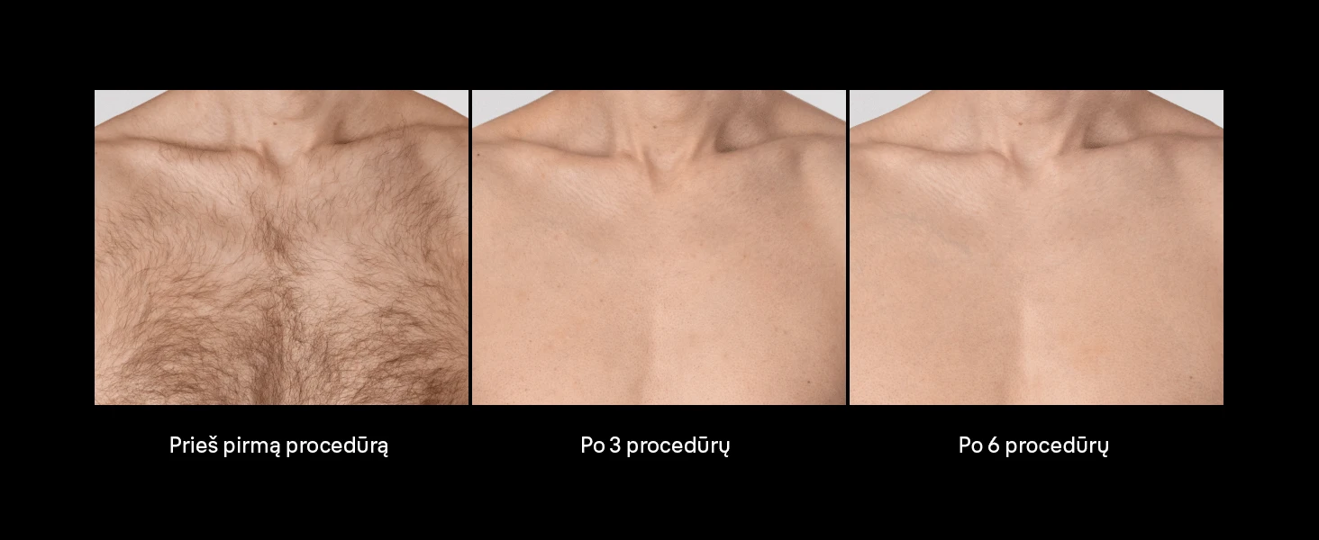 NAUJIENA Braun PL7321 Skin i·expert Pro7 IPL Fotoepiliatorius - Išmanioji alternatyva lazeriui. aprašymas - Prekės nuotrauka