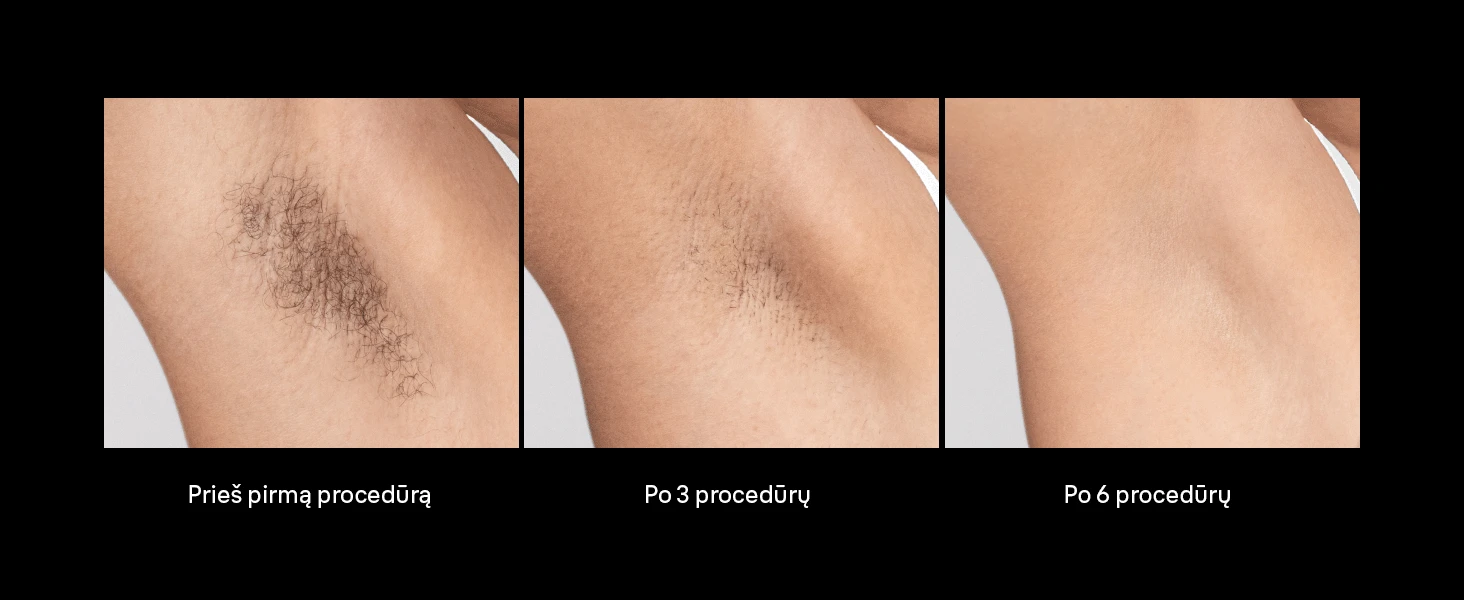 Braun PL7431 Skin i·expert Pro7 IPL Fotoepiliatorius aprašymas - Prekės nuotrauka