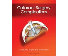 KNYGA Lucio Buratto Md Cataract Surgery Complications