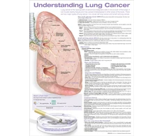 KNYGA Bookshop Understanding Lung Cancer Anatomical Chart
