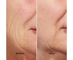 Veido odos atjauninimo aparatas Silk'n FaceTite Revive