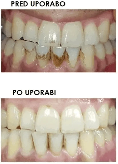 Silkn ToothWave TW1PE3001