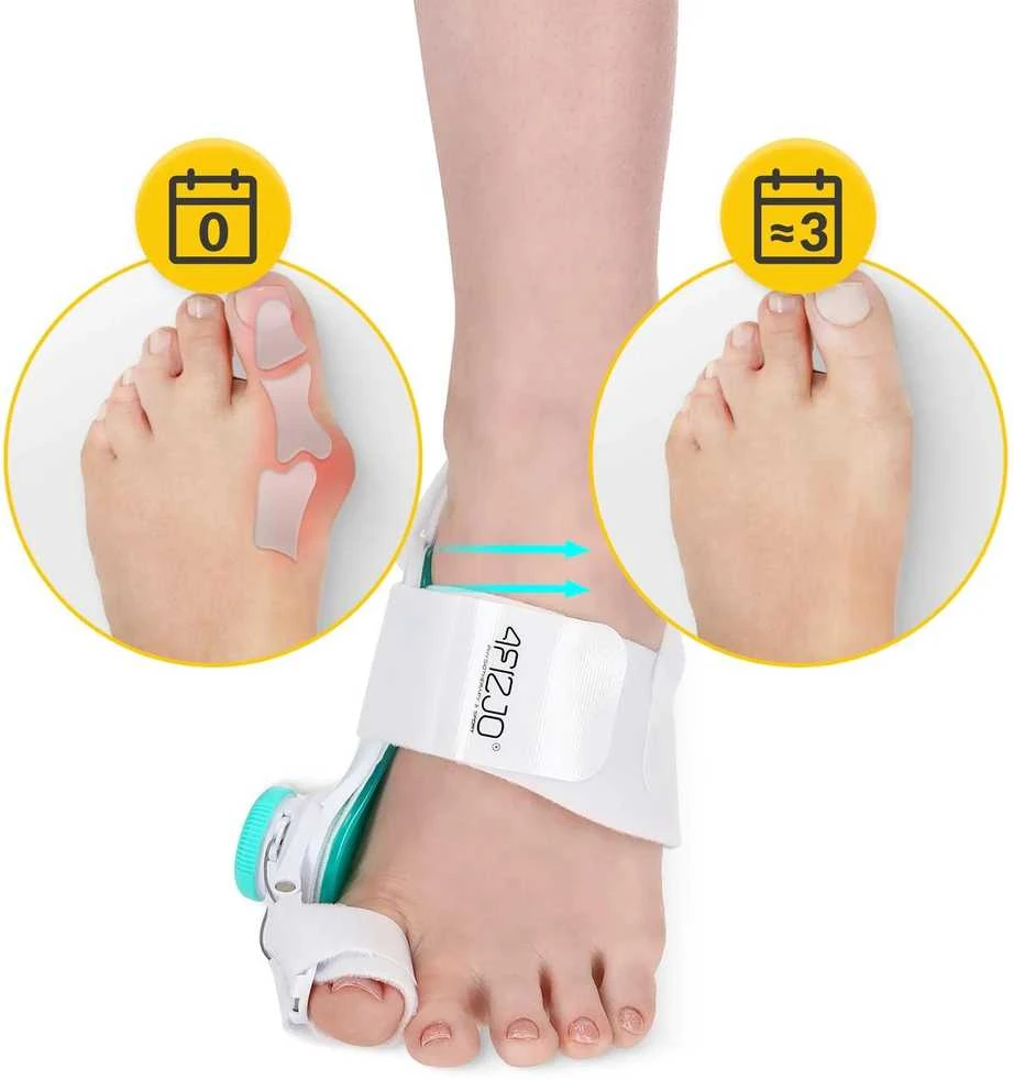 4Fizjo Korekcinis prietaisas nuo hallux valgus deformacijos