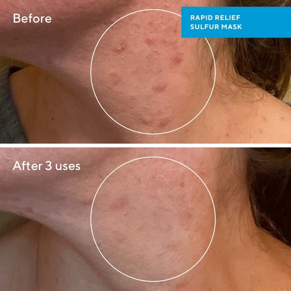 Murad Skincare Murad Rapid Relief Sulfur Mask molio veido kaukė, 75 ml