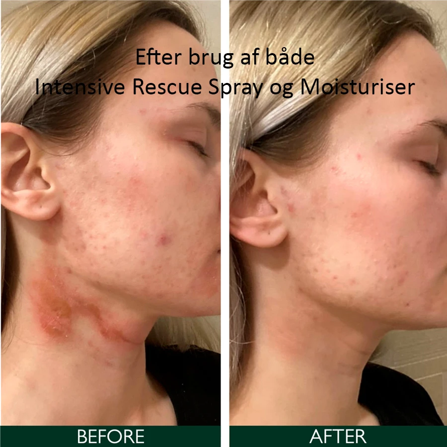 Sorted Skin Intensive Rescue Purškiklis intensyvaus poveikio purškiklis niežtinčiai odai, 100 ml