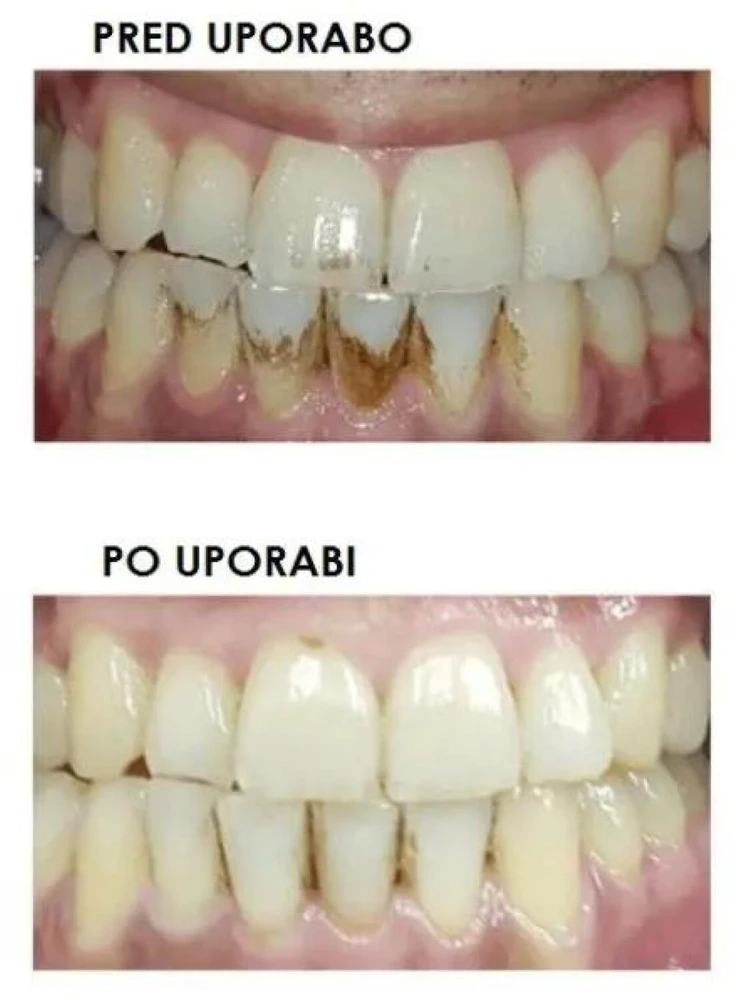 Silkn ToothWave TW1PE3001
