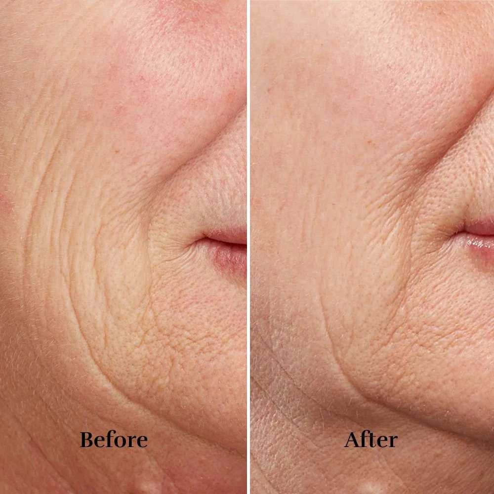 Veido odos atjauninimo aparatas Silk'n FaceTite Revive