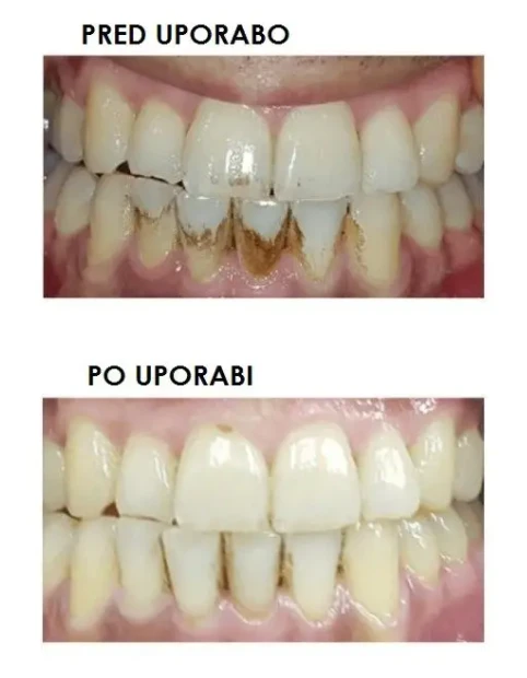 Dantų šepetėlis Silkn ToothWave TW1PE3001