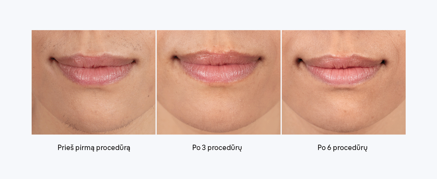 Braun PL5431 Silk-expert Pro 5 IPL fotoepiliatorius aprašymas - Prekės nuotrauka