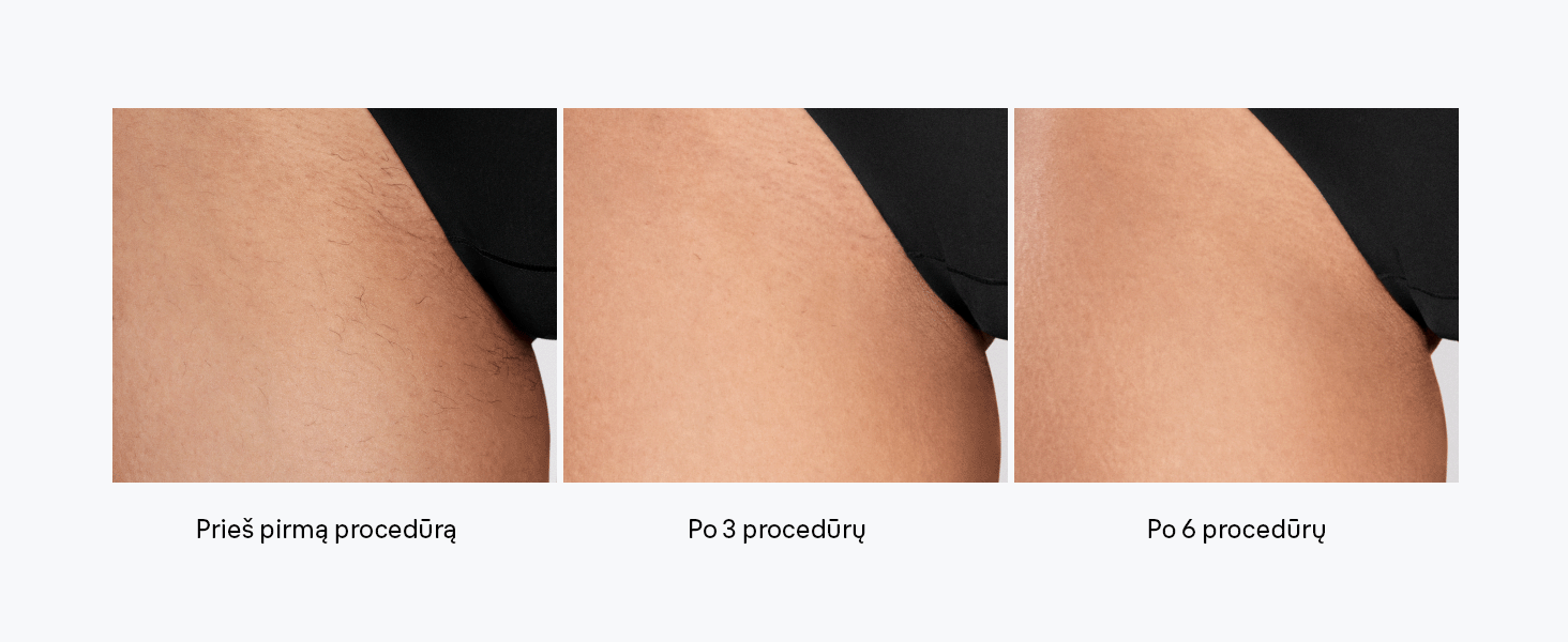 Braun PL5431 Silk-expert Pro 5 IPL fotoepiliatorius aprašymas - Prekės nuotrauka