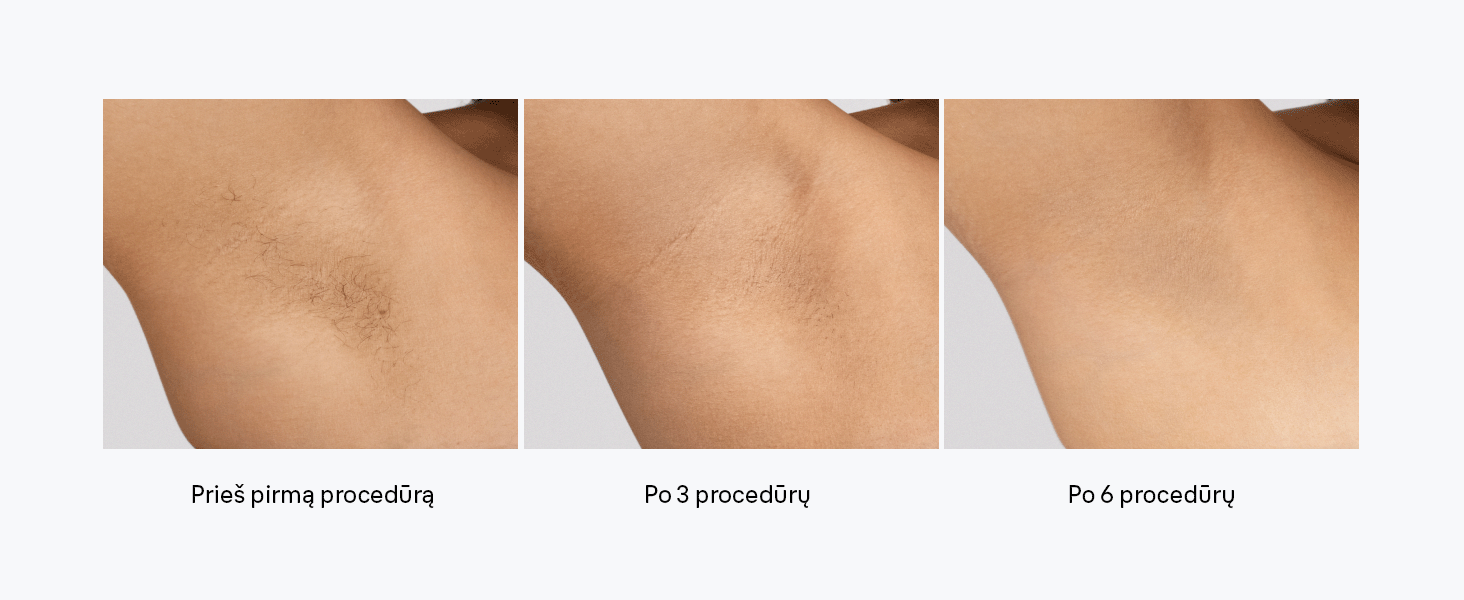 Braun PL5431 Silk-expert Pro 5 IPL fotoepiliatorius aprašymas - Prekės nuotrauka